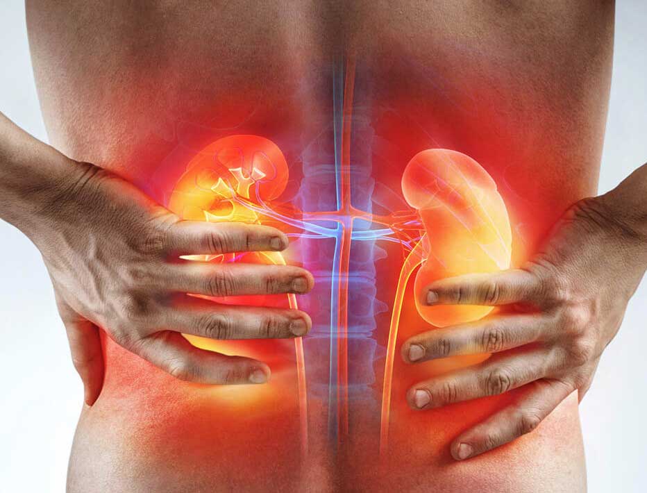 Cólica Renal: o que causa a dor e 5 formas eficazes de prevenir - # ...