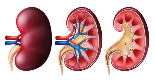 Cólica Renal: o que causa a dor e 5 formas eficazes de prevenir - # ...